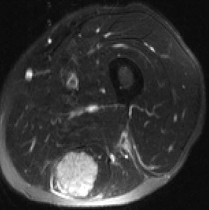 Figure 3 for case Adenocarcinoma lung metastasis